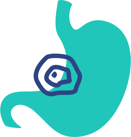Stomach Cancer