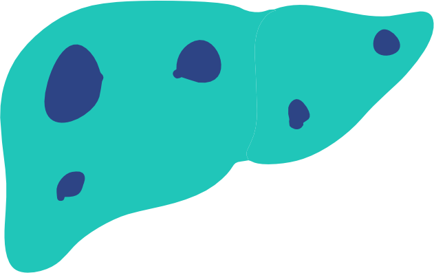 Liver Cysts